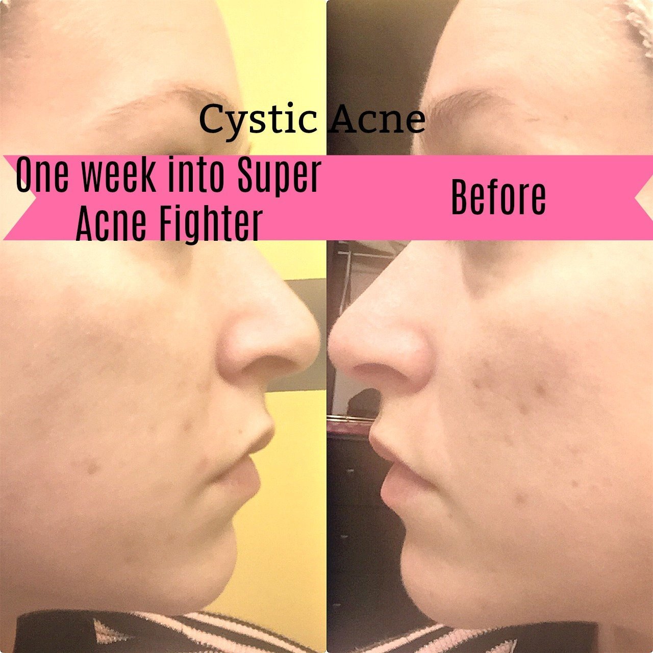 Super Acne Fighter / Organic Acne Treatment / Acne / Essential Oils / - Organify Me