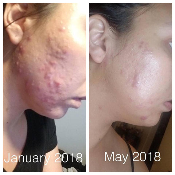 Super Acne Fighter / Organic Acne Treatment / Acne - Organify Me