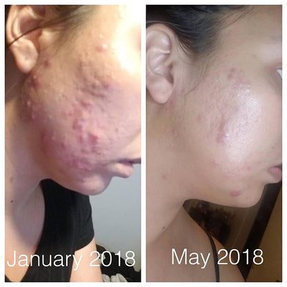 Super Acne Fighter / Organic Acne Treatment / Acne - Organify Me